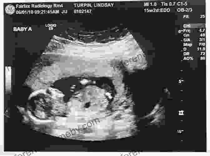 An Ultrasound Image Of A Fetus At 16 Weeks Gestation Life Before Birth: The Challenges Of Fetal Development